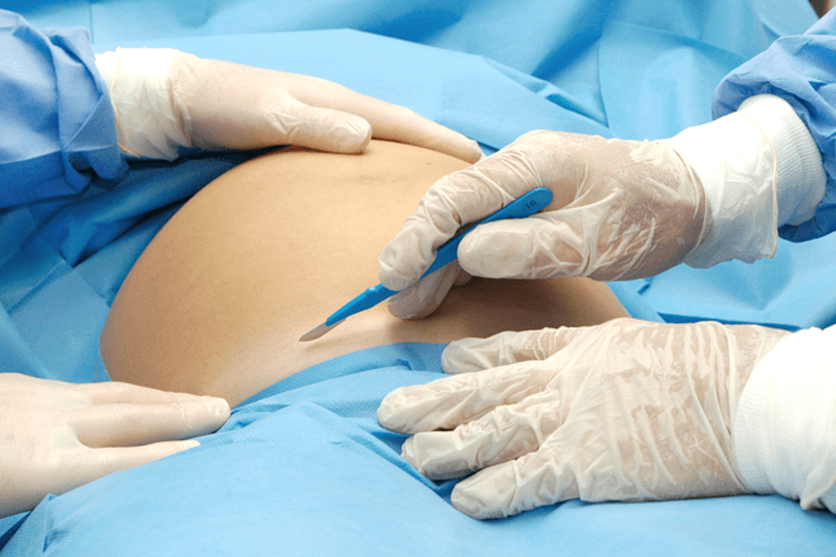 Операции перед беременностью. Операция кесарева сечения. Операция кесарева Сечени. Операция кесаререва сечения.